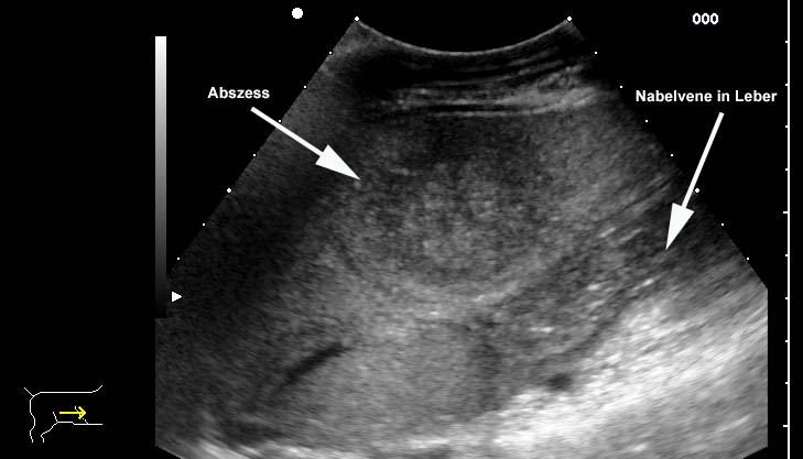 Omphalophlebitis mit Leberbeteiligung