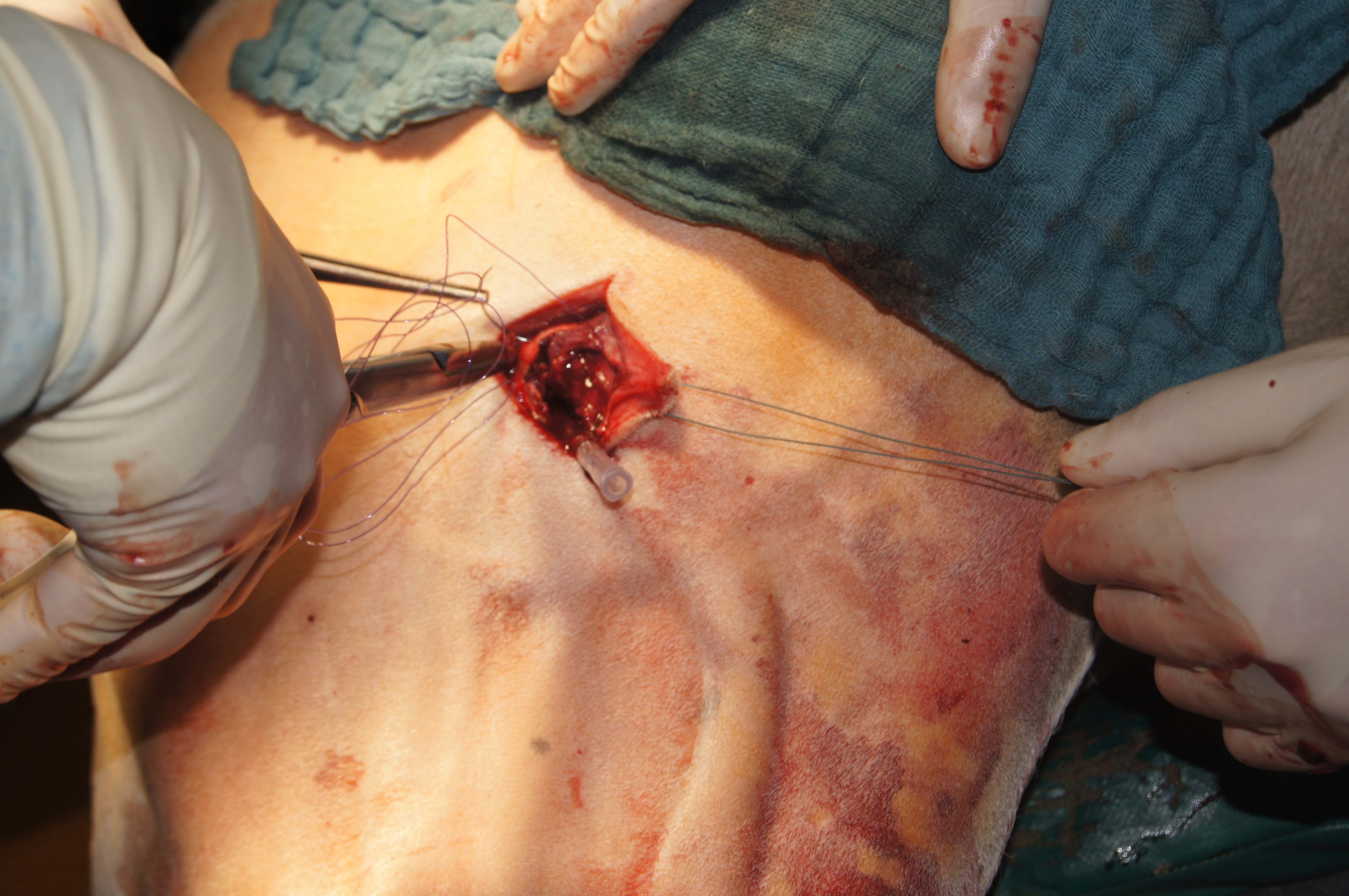 Trepanation